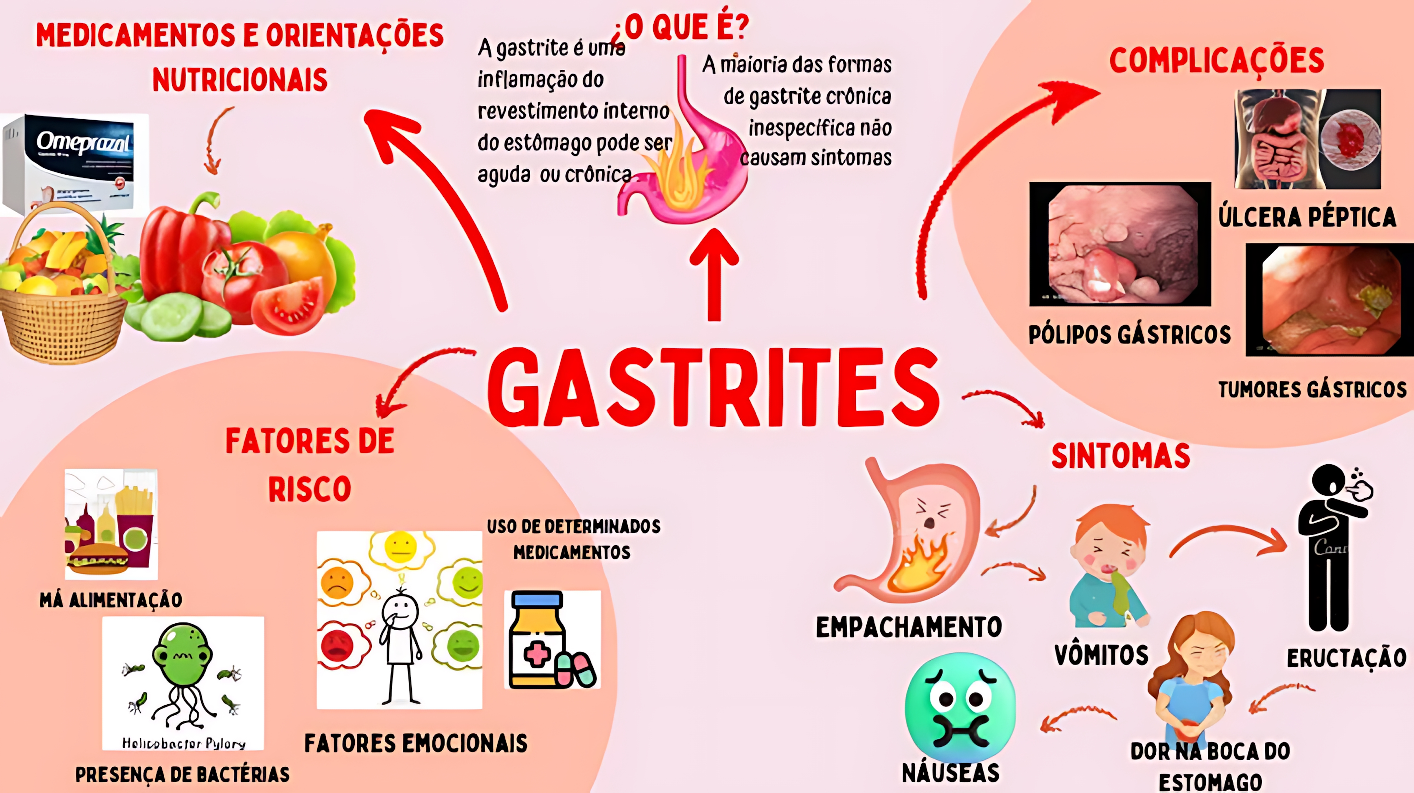 MAPA MENTAL SOBRE GASTRITE