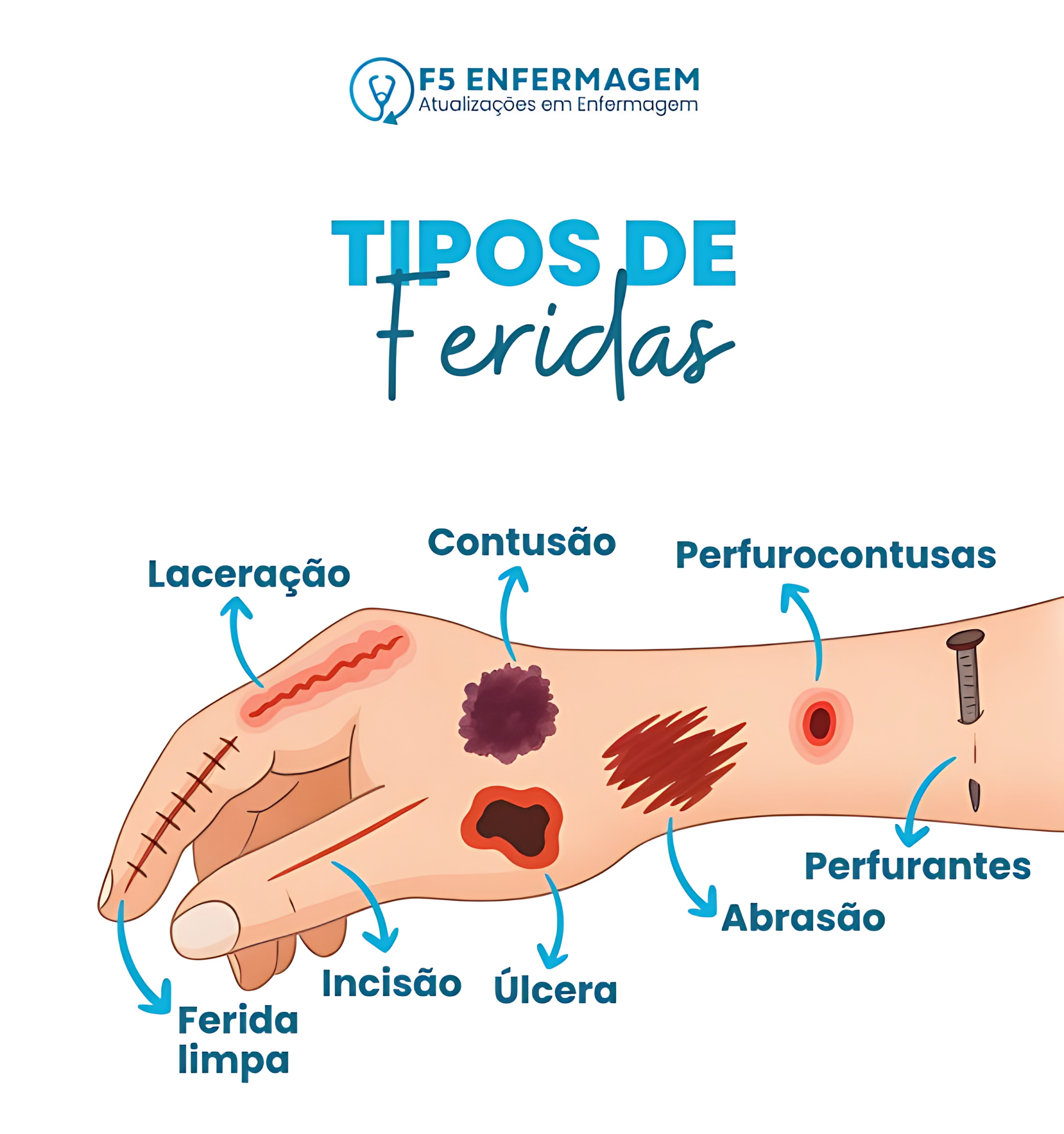 MAPA MENTAL SOBRE TIPOS DE FERIDAS