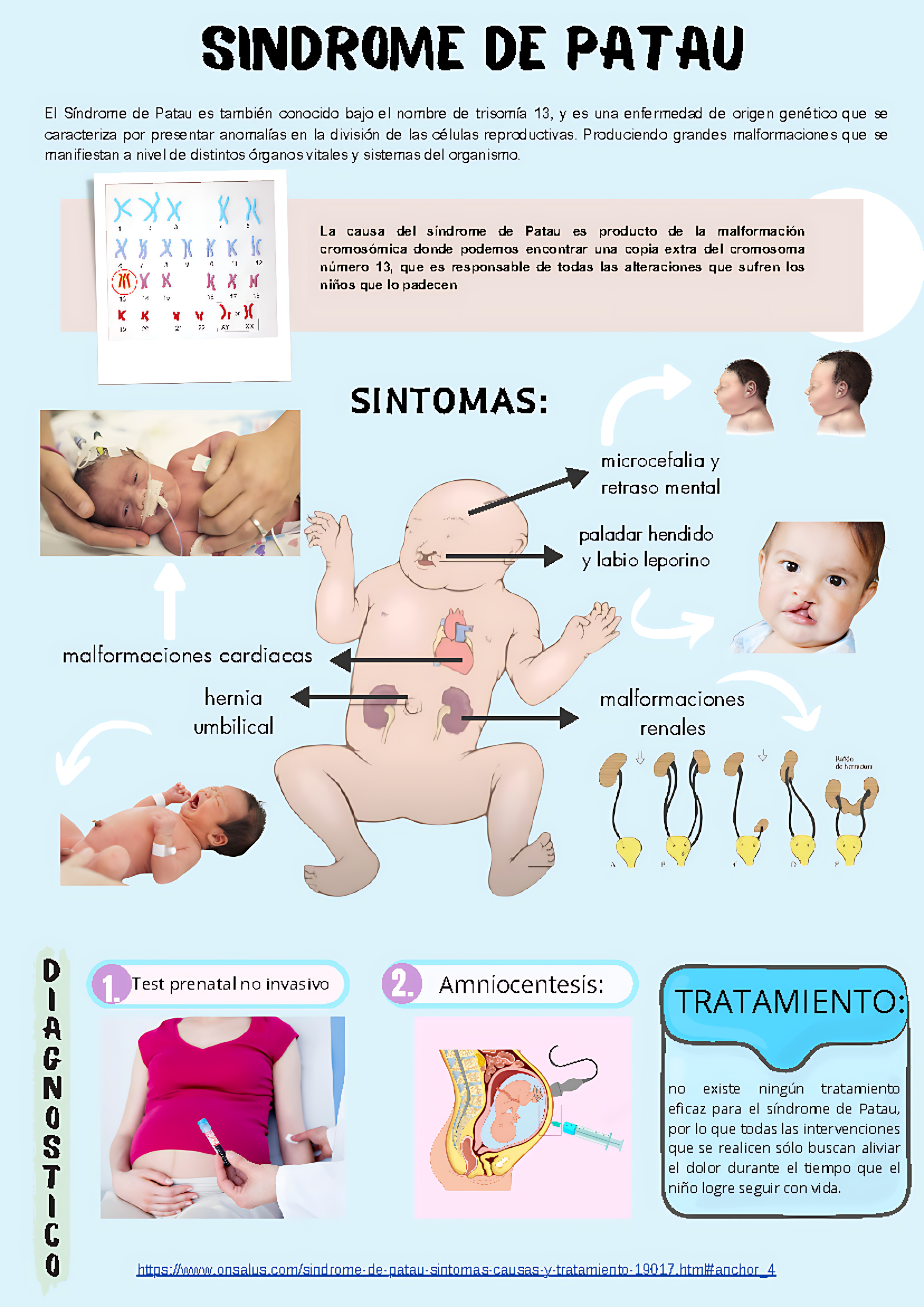 MAPA MENTAL SOBRE SÍNDROME DE PATAU