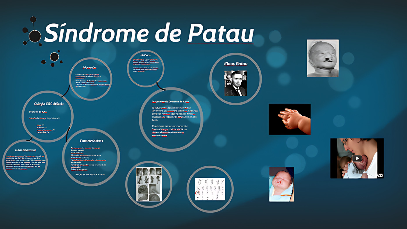 MAPA MENTAL SOBRE SÍNDROME DE PATAU