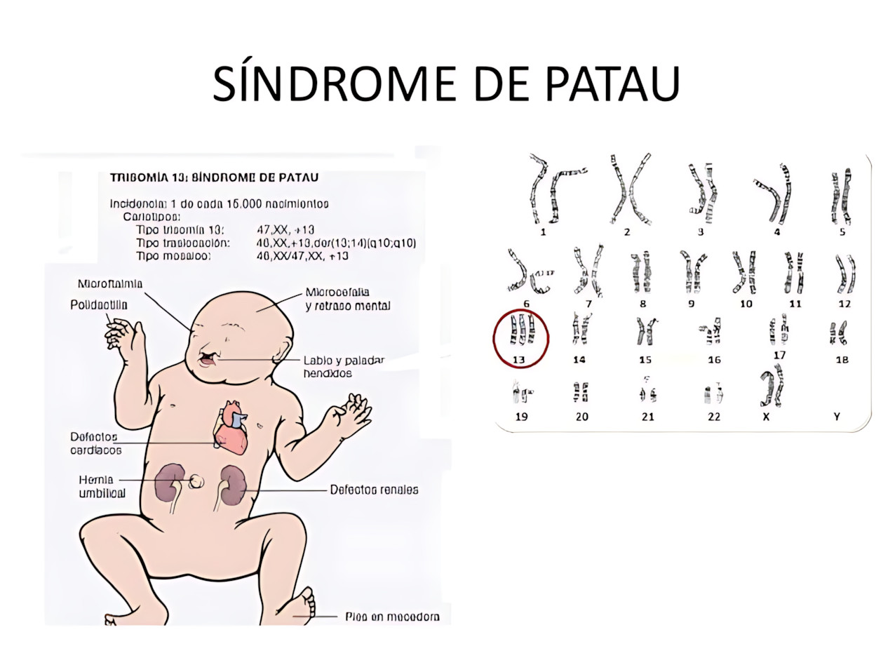 MAPA MENTAL SOBRE SÍNDROME DE PATAU